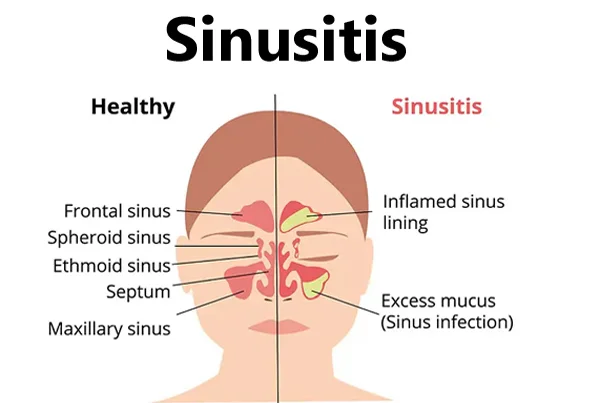 Sinus Infection